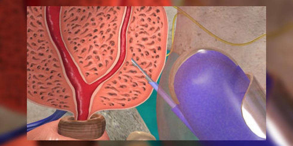 Простата хочет. Пункционная биопсия предстательной железы. Трансперинеальная биопсия. Сатурационная биопсия. Венозный стаз предстательной железы.